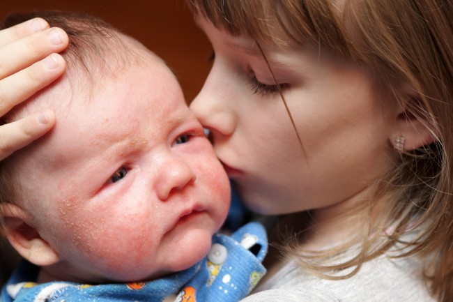 eczema in babies